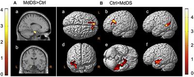 Neuroimaging Markers of Mal de Débarquement Syndrome